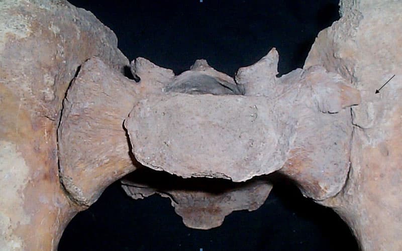 Scheletul 1. Articulaţia sacro - iliacă, săgeata indică o exostoză pe marginea coxalului stâng ce se învecinează cu o alta de pe aripa sacrală, care este şi articulară