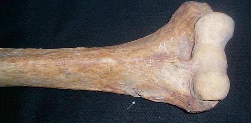 Scheletul 2. Humerus dreapta. Săgeata indică o lovitură perimortem cu un obiect ascuţit ce a crestat marginea laterală a părţii inferioare a diafizei
