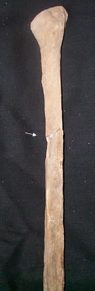 Scheletul 2. Peroneul stâng cu o fractură perimortem