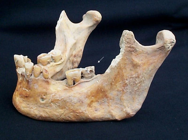 Scheletul 1. Mandibulă: vedere laterală. Săgeata indică o carie penetrantă vestibulară la coletul molarului