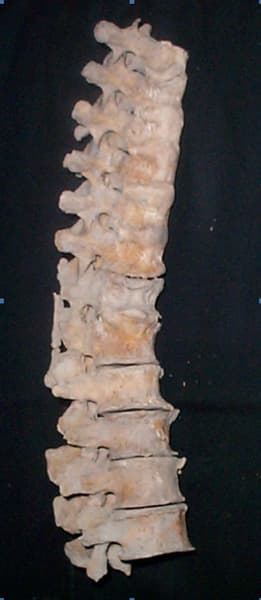 Coloana vertebrală. Segmentul toracal T 5 - T 12 şi lombar L 1 - L 4. Vedere laterală dreapta. Se remarcă blocul vertebral format de cele 8 vertebre toracice