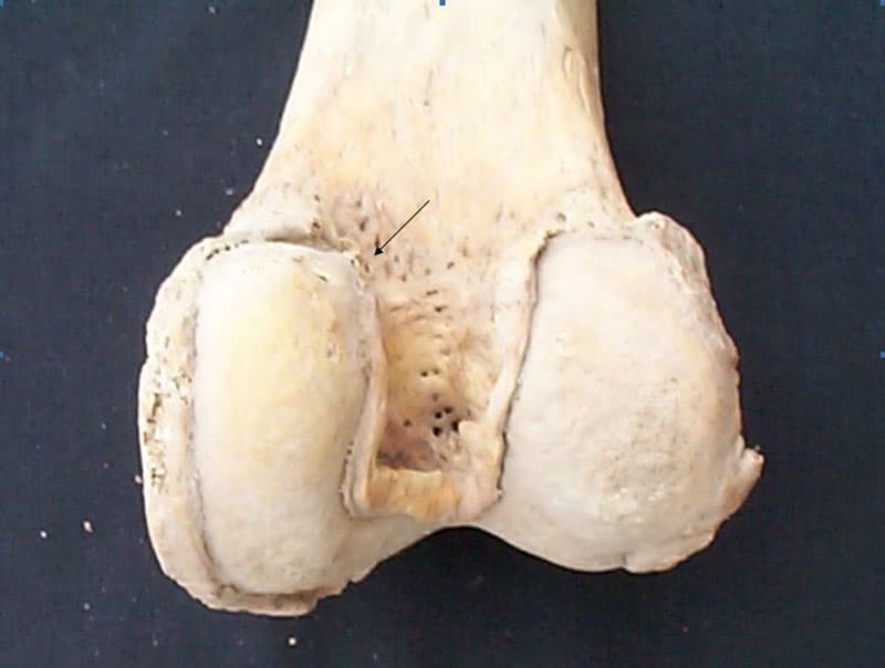 Scheletul 1. Epifiza distală a femurului drept: vedere posterioară, săgeata indică zonele de polizare cu aspect de fildeş. Se remarcă puternicele transformări artrozice
