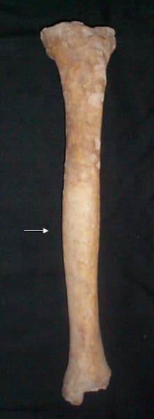 Scheletul 1. Tibie stânga, vedere generală, săgeata indică îngroşarea deosbită şi curbarea spre medial a diafizei (periostită)